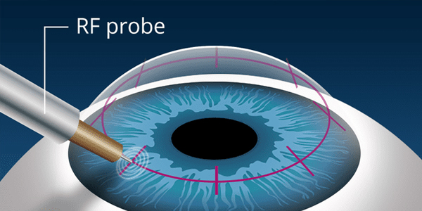 Post operative lasik care